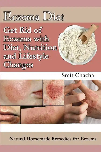 Eczema Diet - Get Rid of Eczema with Diet, Nutrition and Lifestyle Changes: Natural Homemade Remedies for Eczema - Paperback