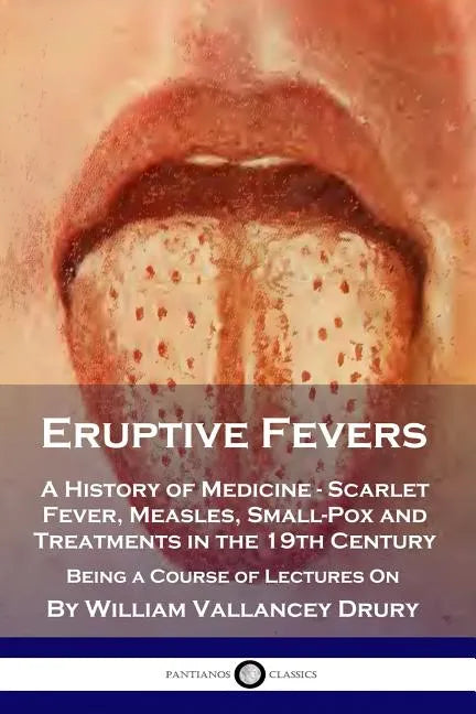 Eruptive Fevers: A History of Medicine - Scarlet Fever, Measles, Small-Pox and Treatments in the 19th Century - Being a Course of Lectures On - Paperback