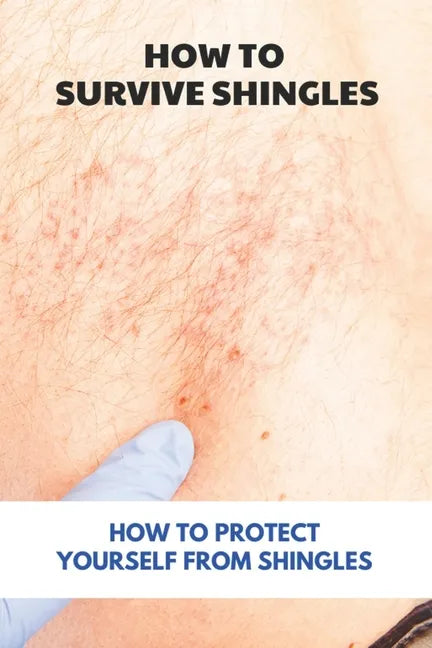 How To Survive Shingles: How To Protect Yourself From Shingles: How To Speed Up Shingles Recovery - Paperback